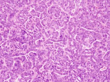 Fig. 25.36, Papillary serous carcinoma. Papillae are less evident and growth is more solid with interspersed ramifying slitlike spaces.