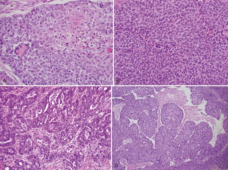 Fig. 25.37, SET (solid, endometrioid-like, and transitional) patterns of high-grade müllerian carcinoma that are considered by many to be variants of serous carcinoma. A, Grade 3 endometrioid adenocarcinoma for comparison. B, Solid pattern of high-grade serous carcinoma (HGSC). Note the greater variation in nuclear morphology and staining. C, Endometrioid-like pattern of HGSC shows some preservation of pseudostratification. D, The “transitional” preserves some papillary morphology. Note however the high nuclear grade in keeping with a variant of HGSC.