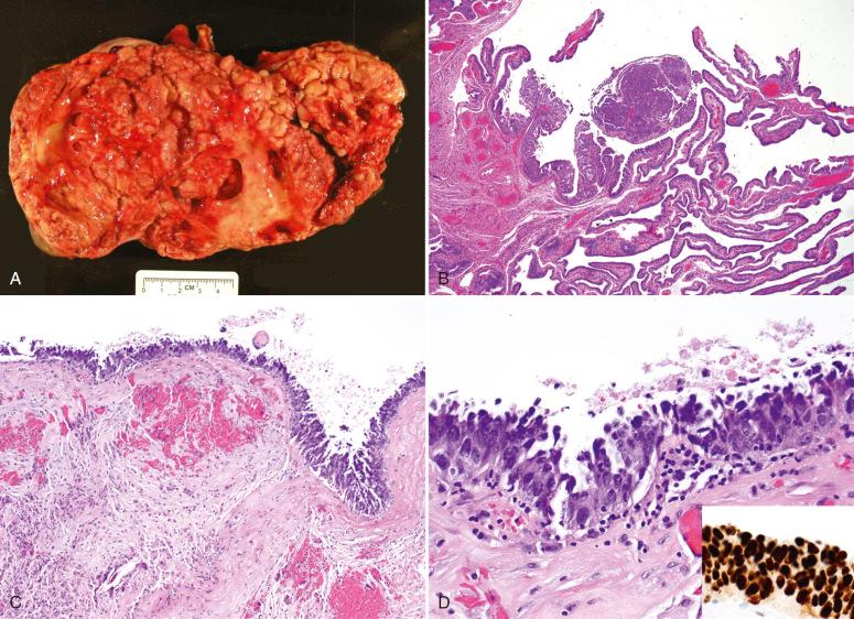 Fig. 25.38, Coexistence of serous tubal intraepithelial carcinoma (STIC) and high-grade serous carcinoma (HGSC). A, HGSC. B, Coexisting STIC. C, Hemorrhagic cyst of the ovary with HGSC. D, At higher magnification. Strong p53 staining is seen in the inset.