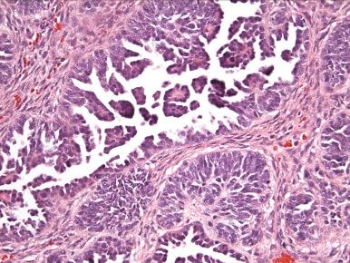 Fig. 25.39, Retiform variant of Sertoli-Leydig cell tumor.