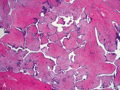 Fig. 25.40, Malignant mesothelioma involving the peritoneum (A), involving the ovarian surface (B), and at high grade involving the ovarian surface (C).