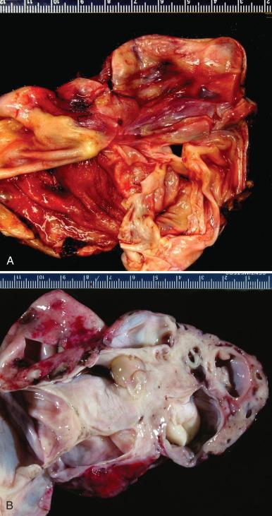 Fig. 25.4, A, Serous cystadenoma. A fibrous cyst wall of variable thickness is partially opened to reveal an irregular but largely smooth surface. B, Serous cystadenofibroma. There are multiple white fibrous cysts lined by small nodules (right).