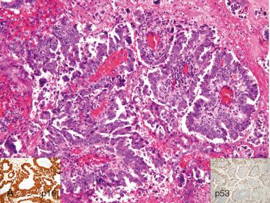 Fig. 25.41, A, Papillary “serous” carcinoma of the cervix retains a wild-type pattern of p53 immunopositivity (lower right inset). However, like high-grade ovarian serous carcinomas, it will stain strongly for p16 (lower left inset). B, A high-grade serous carcinoma (HGSC) is intensely and diffusely positive. C, Another HGSC is devoid of p53 staining, consistent with a truncating mutation.