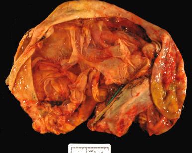 Fig. 25.43, Mucinous cystadenoma. The interior contains numerous smooth cysts of varying sizes.