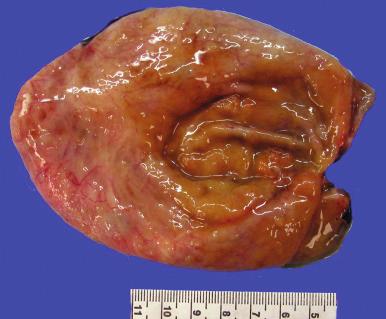 Fig. 25.44, Mucinous cystic tumor, müllerian (endocervical) type. This is a unilocular cyst, presumably arising from an endometrioma.