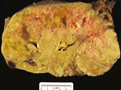 Fig. 25.46, Mucinous carcinoma. The tumor is mostly solid with focal hemorrhage and necrosis.