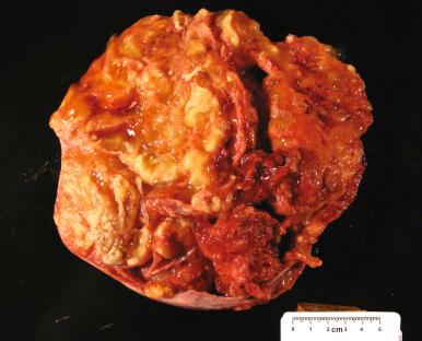 Fig. 25.47, Metastatic mucinous carcinoma from the colon for comparison. Metastatic disease must be excluded in any bilateral mucinous tumor that is grossly malignant.