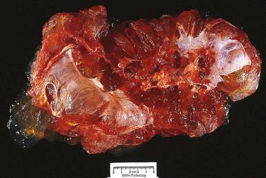 Fig. 25.48, Mucinous cystic tumor in the setting of pseudomyxoma peritonei. The tumor is gelatinous with adherent blobs of mucin on the surface.