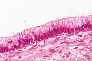 Fig. 25.49, Mucinous cystadenoma. The cyst lining cells are columnar with pale cytoplasm and basal nuclei.