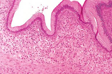 Fig. 25.50, Mucinous cystadenoma with stromal luteinization. The pale luteinized stromal cells cling to the periphery of the epithelial lining cells. These cells may sometimes be the source of hormone production in mucinous tumors.