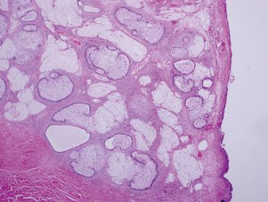 Fig. 25.51, Mucinous borderline tumor with extravasation of mucin and histiocytes.