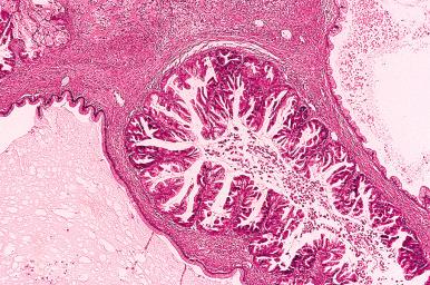 Fig. 25.53, Mucinous borderline tumor, intestinal type. Two benign cysts flank a cyst lined with proliferative epithelium.