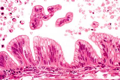 Fig. 25.55, Mucinous borderline tumor, intestinal type. Low-grade mucinous epithelial cells with pseudostratification resulting from the plane of sectioning of the papillae.