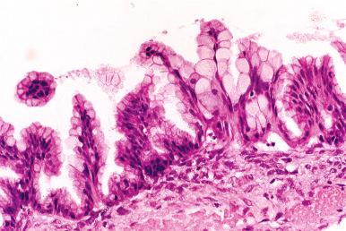 Fig. 25.56, Mucinous borderline tumor, intestinal type. Columnar cells and goblet cells are present.