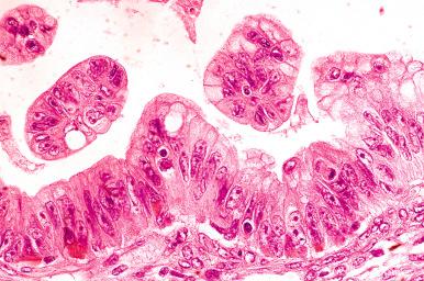 Fig. 25.57, Mucinous borderline tumor with intraepithelial carcinoma. Malignant-appearing epithelial cells with only minimal stratification.