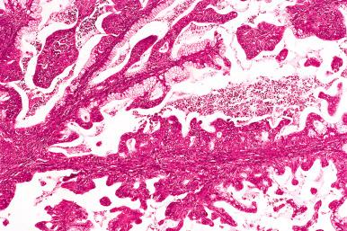 Fig. 25.58, Mucinous borderline tumor with intraepithelial carcinoma. At low power, the cysts are lined by stratified epithelium with and without mucinous cytoplasm.