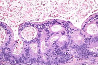 Fig. 25.60, Mucinous borderline tumor with intraepithelial carcinoma. A cribriform intracystic growth pattern is present.