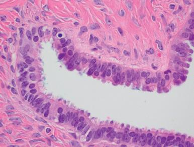 Fig. 25.6, Serous papillary adenofibroma. The epithelial cells are columnar and nonstratified and appear to be benign.