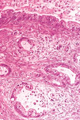 Fig. 25.61, Mucinous borderline tumor with microinvasion. Single cells appear to break off into the stroma from adjacent glands.