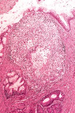 Fig. 25.62, Mucinous borderline tumor with pseudoinvasion. A strip of benign-appearing mucinous cells is present in a large field of histiocytes secondary to cyst rupture and mucin extravasation.