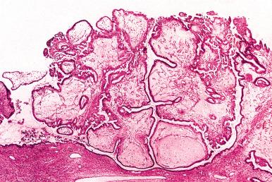 Fig. 25.63, Endocervical-like mucinous borderline tumor. The low-power appearance mimics a serous borderline tumor (SBT) with bulbous papillae.