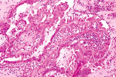 Fig. 25.65, Endocervical-like mucinous borderline tumor. In this focus, highly stratified eosinophilic cells line the papillae. There are numerous leukocytes in the papillae and in the mucin.