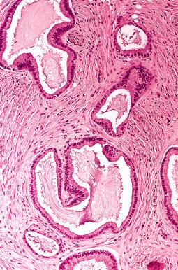 Fig. 25.67, Omental implant from an endocervical-like mucinous borderline tumor. At high magnification, the epithelial cells appear benign.