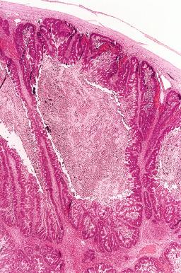 Fig. 25.68, Mucinous carcinoma with expansile invasion. Numerous cysts are lined by papillary epithelium. The cysts are sharply demarcated and do not extend to the overlying ovarian surface.