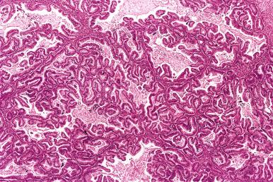 Fig. 25.69, Mucinous carcinoma with expansile invasion. Complex spaces with little intervening stroma occupy the entire field.