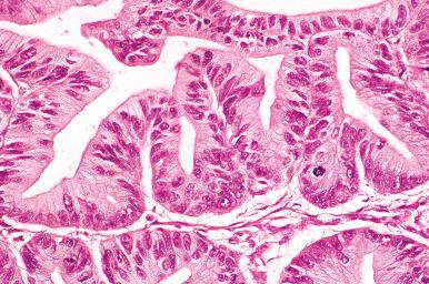 Fig. 25.70, Mucinous carcinoma with expansile invasion. The epithelial cells lining the spaces appear mucinous.