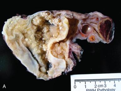 Fig. 25.7, Serous borderline tumor (SBT). A, An opened cyst contains myriad small papillae. B, A surface borderline tumor projects from the cortex of the ovary (bottom).