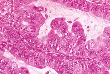 Fig. 25.71, Mucinous carcinoma with expansile invasion. The epithelial cells in this case have a nondescript eosinophilic cytoplasm.