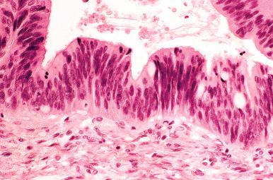 Fig. 25.72, Mucinous carcinoma with expansile invasion. The epithelial cells appear somewhat endometrioid. The slender nuclei and surface cytoplasmic mucin are consistent with a mucinous tumor.