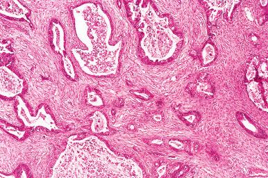 Fig. 25.73, Mucinous carcinoma with infiltrative invasion. Irregularly shaped glands and cysts are set in a desmoplastic stroma.