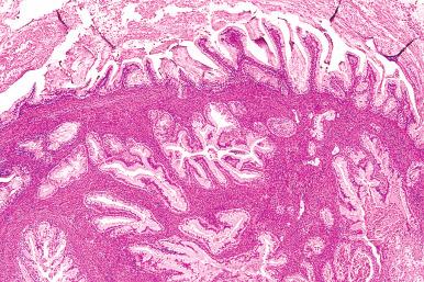 Fig. 25.75, Mucinous carcinoma with infiltrative invasion. The glands are widely spaced and the stroma is cellular and fibromatous, which might cause confusion with a borderline tumor with intraepithelial carcinoma.