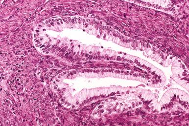 Fig. 25.76, Mucinous carcinoma with infiltrative invasion. A high-magnification view of the tumor in Fig. 25.75 . This well-differentiated carcinoma with a fibromatous stroma might be confused with a borderline tumor with intraepithelial carcinoma.