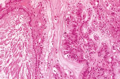 Fig. 25.77, Mucinous carcinoma of the endocervical-like type (seromucinous carcinoma). At low power, the spaces are filled with pale mucinous material. The glands and papillae are lined by benign-appearing and only mildly atypical mucinous epithelial cells.