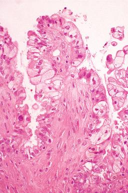 Fig. 25.78, Mucinous carcinoma, endocervical-like type (seromucinous carcinoma). The epithelial lining cells are well differentiated and resemble those of the endocervix.