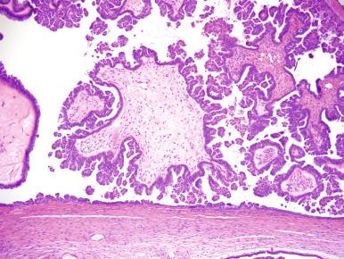 Fig. 25.8, Serous borderline tumor (SBT). Broad, edematous papillae with numerous smaller daughter papillae projected into a cystic space.