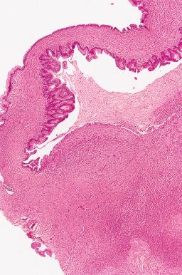 Fig. 25.81, A mural nodule with anaplastic carcinoma in a mucinous tumor. The wall of a cyst is replaced by a solid cellular proliferation.