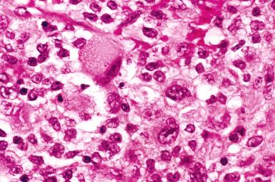 Fig. 25.82, A mural nodule with anaplastic carcinoma in a mucinous tumor. At high power, the nodule is composed of anaplastic cells, some with a rhabdoid appearance.