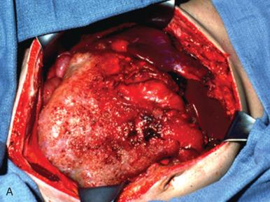 Fig. 25.83, A, Intraoperative image of mucinous ascites associated with a mucinous neoplasm. B, Pseudomyxoma peritonei with neoplastic epithelium admixed with extravasated mucous.