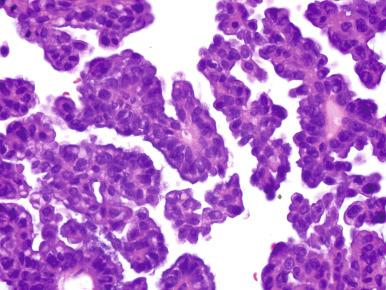 Fig. 25.9, Serous borderline tumor (SBT). Bland epithelial cells around the smaller papillae appear to be free floating in the extracellular space.