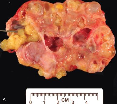 Fig. 25.10, Serous borderline tumor (SBT) with mucoid material. A, Gross pathology. B, Stringy mucinous material occupies the extracellular space around the papillae.