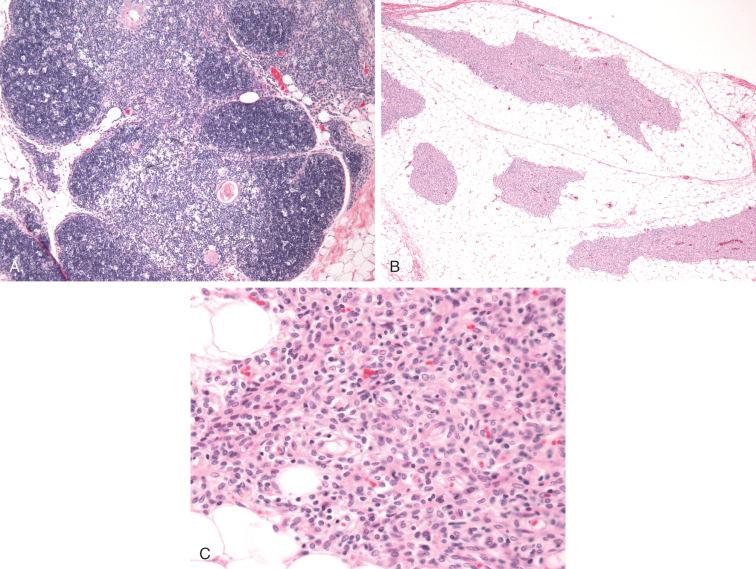 Figure 54-1, Example of thymus histology in PID.