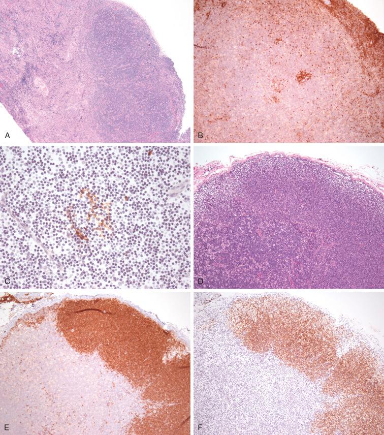 Figure 54-2, Two examples of hyper IgM syndrome related to CD40L deficiency.