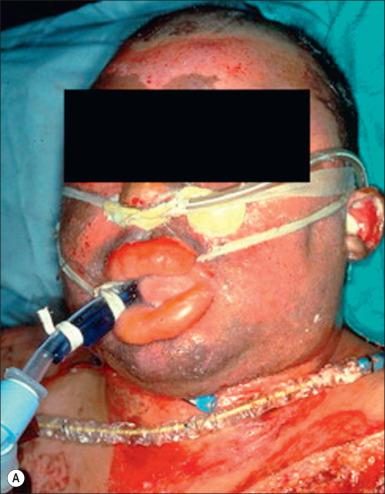 Fig. 16.3, Facial and airway injury after burn and smoke inhalation. (A) A facial burn is often associated with thermal injury to the upper airway. (B) Hyperemia of airway epithelium. (C) Formation of airway obstructive cast.