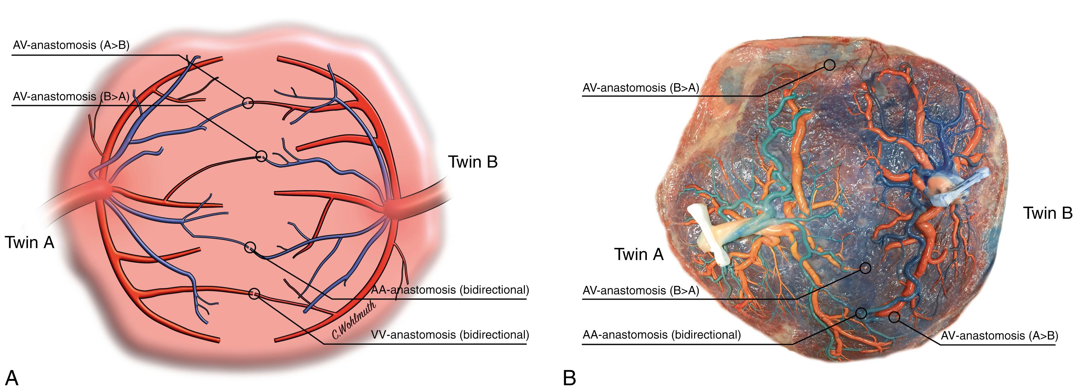 Fig. 149.2, Placental vascular anastomoses. (A) Schematic representation of a monochorionic placenta. More than 95% of all monochorionic placentas show anastomoses along the vascular equator, which can be bidirectional (arterio-arterial [AA] and venovenous [VV] ) or unidirectional (arteriovenous [AV] ). (B) Postnatal placental injection study of a monochorionic pregnancy delivered at 37 weeks of gestation in a pregnancy without complications. A>B , Flow from twin A to B; B>A , flow from twin B to A.