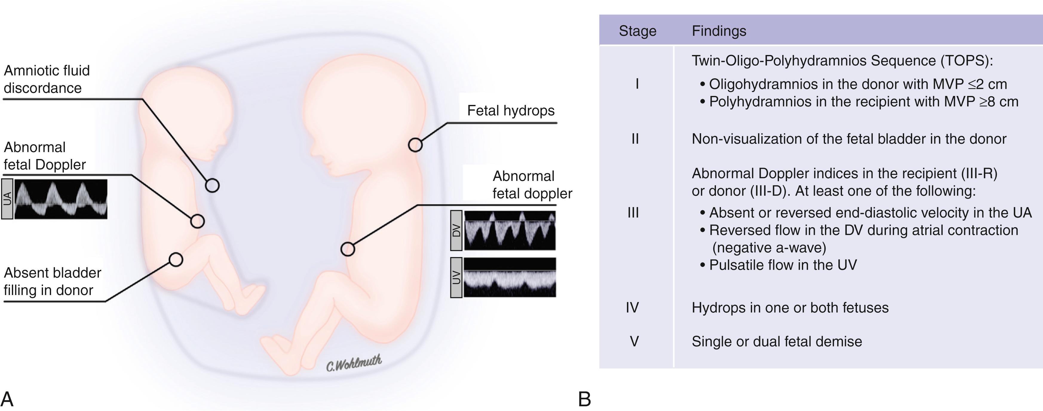 Fig. 149.3, Pathophysiology of twin-twin transfusion syndrome. (A) Schematic representation of the pathophysiology of twin-twin transfusion syndrome with the diagnostic criterion of oligohydramnios in the donor twin and polyhydramnios in the recipient. (B) Staging of twin-twin transfusion syndrome DV , Ductus venosus; MVP , maximal vertical pocket; UA , umbilical artery; UV , umbilical vein.