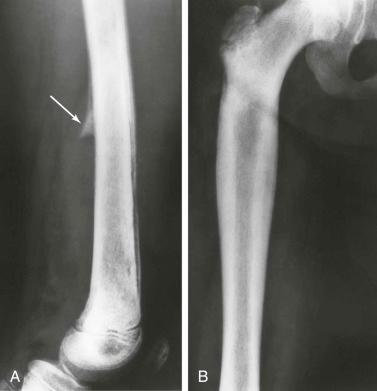 eFIGURE 90-9, A , Atypical presentation of osteomyelitis in a child. The periosteal reaction (arrow) consisting of Codman triangle and interrupted lamellar periosteal reaction is far more commonly seen in sarcoma. Because of this periosteal reaction, the predominantly diaphyseal location, the pattern of bone destruction, and the age of the patient, Ewing sarcoma should be included in the differential diagnosis. B , Ewing sarcoma in a young adolescent presenting with fever, high sedimentation rate, and elevated white cell count. Although this radiograph should raise the suspicion of Ewing sarcoma, the periosteal reaction in Ewing sarcoma usually is less solid than in this patient. Osteomyelitis should be included in the differential diagnosis because of this periosteal reaction and the absence of visible soft tissue mass.